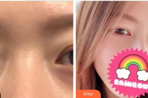 滕州時(shí)光醫(yī)療美容門(mén)診部歐陽(yáng)天祥整形價(jià)格表附內(nèi)切祛眼袋案例展示