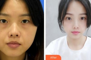 滕州時(shí)光醫(yī)療美容門(mén)診部許士海整形價(jià)格表附激光去眼袋案例展示