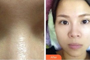 滕州美萊純韓整形醫(yī)院朱丹整形價(jià)格表附切開(kāi)雙眼皮案例展示