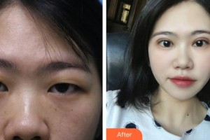 滕州美界醫(yī)療整形診所蘭福良整形價(jià)格表附眼部綜合案例展示