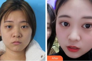 滕州市中心人民醫(yī)院燒傷整形美容科滿(mǎn)中亞整形價(jià)格表附切開(kāi)雙眼皮案例展示