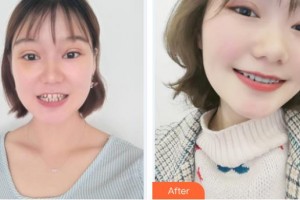 滕州時(shí)光醫(yī)療美容門(mén)診部王文科整形價(jià)格表附隱形托槽矯正案例展示