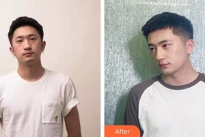 滕州美界醫(yī)療整形診所李承吉整形價(jià)格表附肋軟骨隆鼻案例展示