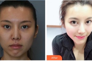 滕州美界醫(yī)療整形診所谷曉紅整形價(jià)格表附鼻部綜合案例展示