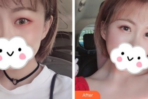 滕州市財(cái)貿(mào)醫(yī)院眼科張悅玲整形價(jià)格表附眼部綜合案例展示