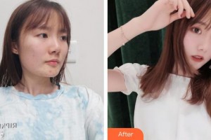 滕州美界醫(yī)療整形診所易彬整形價(jià)格表附切開(kāi)雙眼皮案例展示