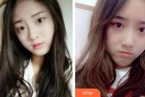 滕州啟明眼科醫(yī)院王靜整形價(jià)格表附切開(kāi)雙眼皮案例展示