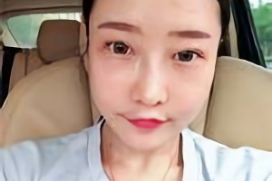 華西口腔醫(yī)院李運(yùn)峰磨骨手術(shù)價(jià)格貴嗎？附價(jià)格表和案例