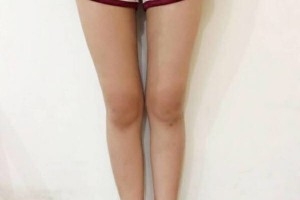 昆明醫(yī)學(xué)院整形美容中心如何？附吸脂瘦腿附果圖及價(jià)格一覽