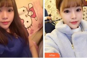 郴州市第一人民醫(yī)院整形美容科胡永才整形價(jià)格表附鼻部綜合案例展示