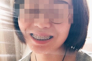 南京市口腔醫(yī)院牙齒矯正果？術(shù)后經(jīng)驗(yàn)分享