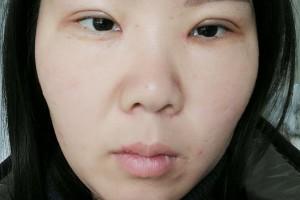 河北醫(yī)科大學(xué)第二醫(yī)院整形美容科雙眼皮手術(shù)哪個(gè)醫(yī)生好附案例