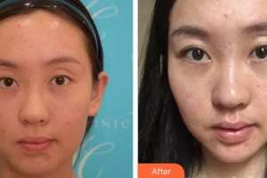 郴州曹家易麗醫(yī)療美容門診部覃翠蘭整形價(jià)格表附清潔祛痘案例展示