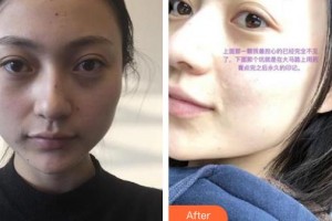 郴州曹家易麗醫(yī)療美容門診部詹慧整形價(jià)格表附激光點(diǎn)痣案例展示