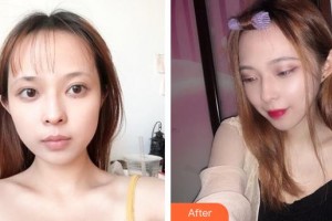 郴州愛思特醫(yī)療美容醫(yī)院易立書整形價格表附彩光嫩膚案例展示