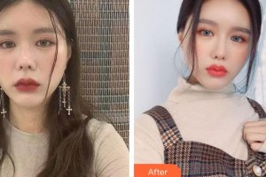 郴州市第四人民醫(yī)院王暉整形價(jià)格表附鼻小柱延長案例展示