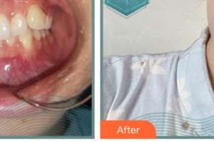 郴州冠華口腔醫(yī)院嚴(yán)國南整形價格表附牙齒隱形矯正案例展示