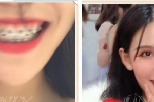 郴州冠華口腔醫(yī)院葛旭明整形價格表附金屬托槽矯正案例展示