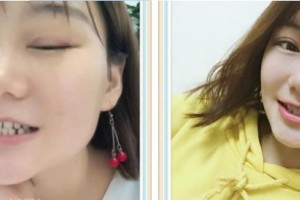 郴州冠華口腔醫(yī)院周飛整形價格表附牙齒隱形矯正案例展示