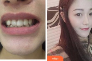 郴州瑞瀾醫(yī)療美容醫(yī)院王莉整形價格表附牙貼面案例展示