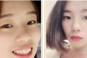 樂清市人民醫(yī)院燒傷整形科胡加林整形價(jià)格表附牙貼面案例展示