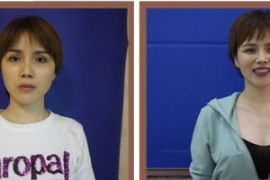 樂清牙科醫(yī)院劉經(jīng)輝整形價(jià)格表附美白貼片案例展示