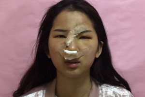 無(wú)錫人民醫(yī)院皮膚美容科隆鼻附果圖+2021價(jià)格表