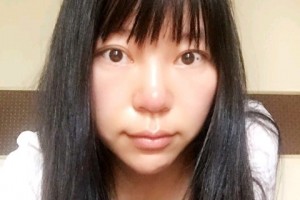 長春西之米林鐘學隆胸手術(shù)附果圖+案例分享