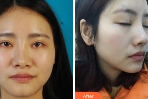 佛山瑞芙臣?jí)袈夺t(yī)學(xué)整形美容醫(yī)院孫增勤整形價(jià)格表附鼻部綜合案例展示