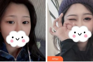 佛山華廈眼科醫(yī)院朱天倫整形價(jià)格表附眼部綜合案例展示