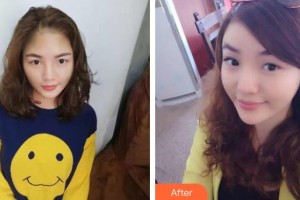 佛山華廈眼科醫(yī)院余建洪整形價(jià)格表附埋線雙眼皮案例展示