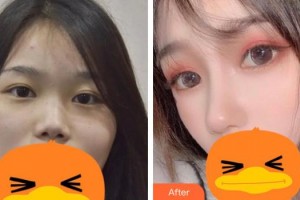 佛山華廈眼科醫(yī)院趙剛平整形價(jià)格表附激光去眼袋案例展示