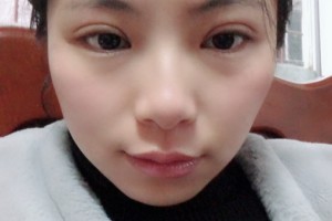 上海南山整容醫(yī)院割雙眼皮手術案例分享附價格表