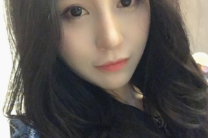 北京大學(xué)深圳醫(yī)院整形外科割雙眼皮果好不好附案例分享