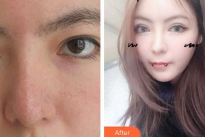 連云港徐楊醫(yī)療美容門診部孫忠林整形價(jià)格表附切開雙眼皮案例展示