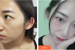 連云港億大整形美容醫(yī)院蘇成勝整形價(jià)格表附激光去眼袋案例展示