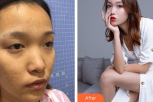 連云港贛榆國(guó)泰整形美容外科診所童飛整形價(jià)格表附眼部綜合案例展示