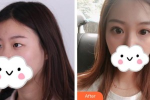 連云港成宏口腔醫(yī)院成宏整形價(jià)格表附眼部綜合案例展示