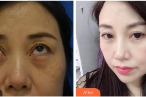南昌大學(xué)附屬眼科醫(yī)院易敬林整形價(jià)格表附激光去眼袋案例展示