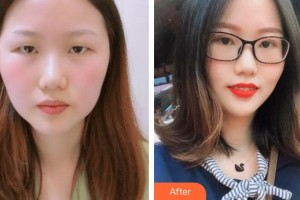 南昌大學附屬眼科醫(yī)院周文天整形價格表附切開雙眼皮案例展示