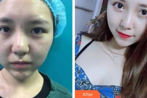 南昌大學附屬眼科醫(yī)院楊璐整形價格表附切開雙眼皮案例展示