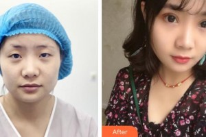 南昌大學附屬眼科醫(yī)院黃傳華整形價格表附眼部綜合案例展示