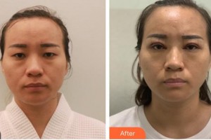 南昌大學附屬眼科醫(yī)院劉莉莉整形價格表附開內眼角案例展示