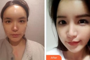 南昌大學附屬眼科醫(yī)院易昀敏整形價格表附眼部綜合案例展示