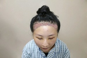 江蘇省常熟市第二人民醫(yī)院哪個醫(yī)生植發(fā)好附案例和醫(yī)生推薦