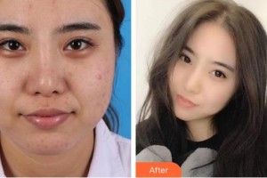 南昌大學(xué)附屬眼科醫(yī)院劉秋平整形價(jià)格表附切開雙眼皮案例展示