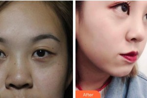 南昌愛爾眼科醫(yī)院朱加貴整形價(jià)格表附定點(diǎn)雙眼皮案例展示