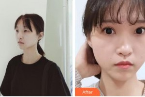 南昌愛爾眼科醫(yī)院易文殊整形價(jià)格表附眼部綜合案例展示