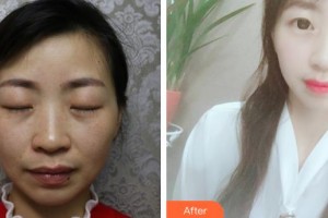 南昌愛爾眼科醫(yī)院盧恒松整形價(jià)格表附眼部綜合案例展示