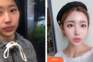 南昌普瑞眼科醫(yī)院劉娜整形價格表附眼部綜合案例展示